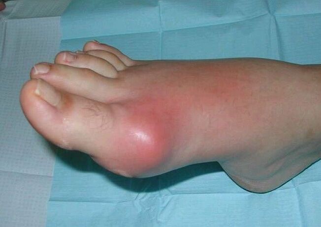 Cuadro clínico de la artritis del pie hinchazón e inflamación. 
