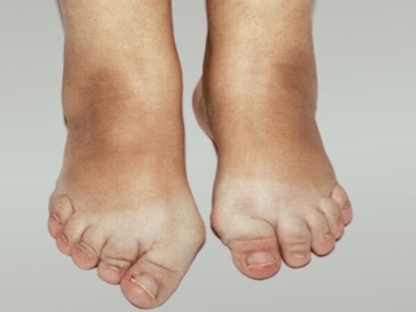 Osteoartritis del pie con deformación severa de los dedos. 