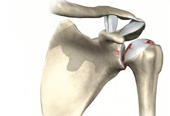 Articulación del hombro afectada por osteoartritis