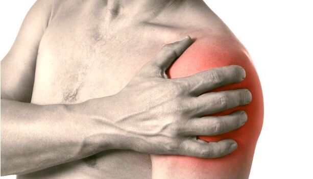 Un hombro hinchado, enrojecido y agrandado síntomas de osteoartritis de grado 2-3 de la articulación del hombro