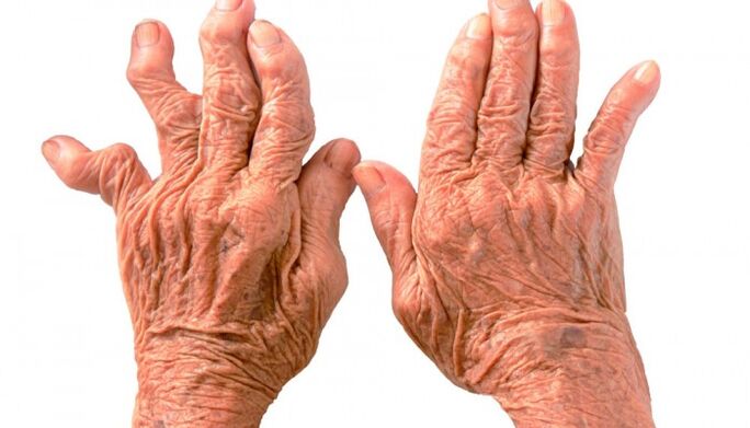 artritis reumatoide como causa de dolor en las articulaciones de los dedos