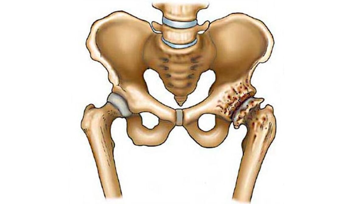 Daño a la articulación de la cadera en presencia de osteoartritis.