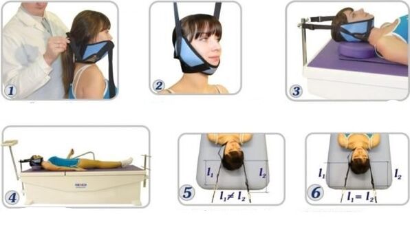 Tratamiento de la osteocondrosis cervical mediante tracción.