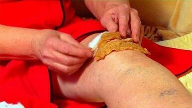 Compresas para la osteoartritis de la articulación de la rodilla