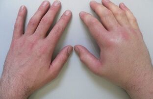 Artralgia como causa de dolor en las articulaciones de los dedos. 