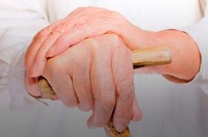 Dolor en las articulaciones de los dedos con artritis reumatoide. 