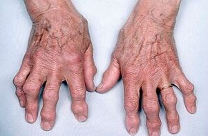 cómo deshacerse del dolor en las articulaciones de los dedos