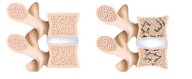 Osteoporosis eliminación de calcio de los huesos. 