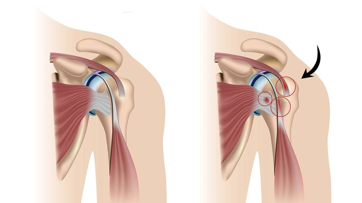 La inflamación de los tejidos blandos alrededor de la articulación causa un dolor intenso. 