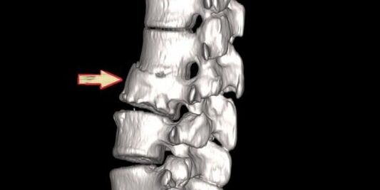 Patología espinal como causa de dolor de espalda. 