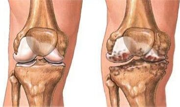 Osteoartritis de rodilla