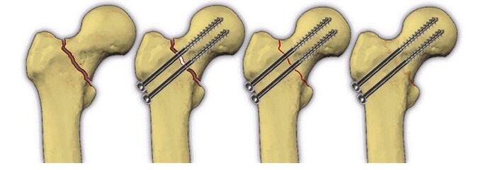 Fijación del cuerpo óseo con pasadores para el dolor en la articulación de la cadera. 
