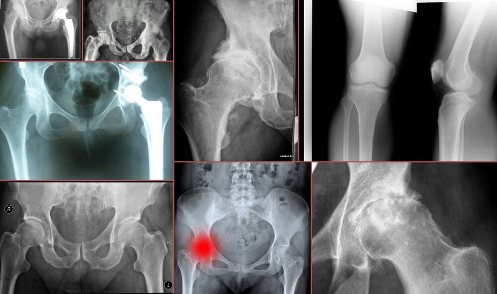 Radiografía para el dolor de cadera