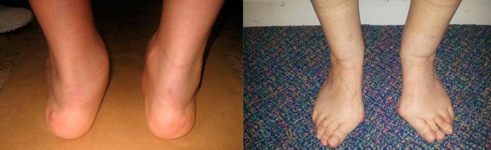 Artrosis del dedo gordo del pie y artrosis deformante del tobillo