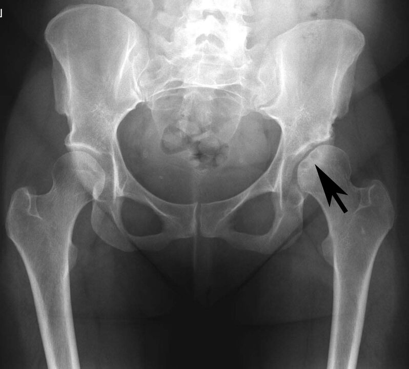 Depósito de sales de calcio en la articulación de la cadera con pseudogota en la radiografía