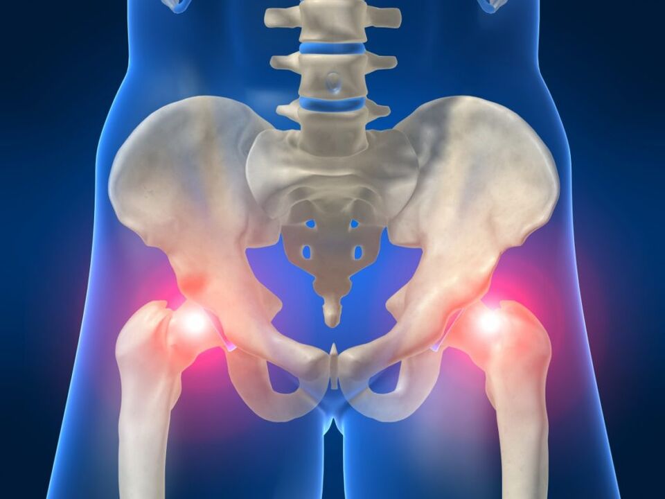 El dolor en ambos lados de la articulación de la cadera es preocupante en la enfermedad de Bechterew