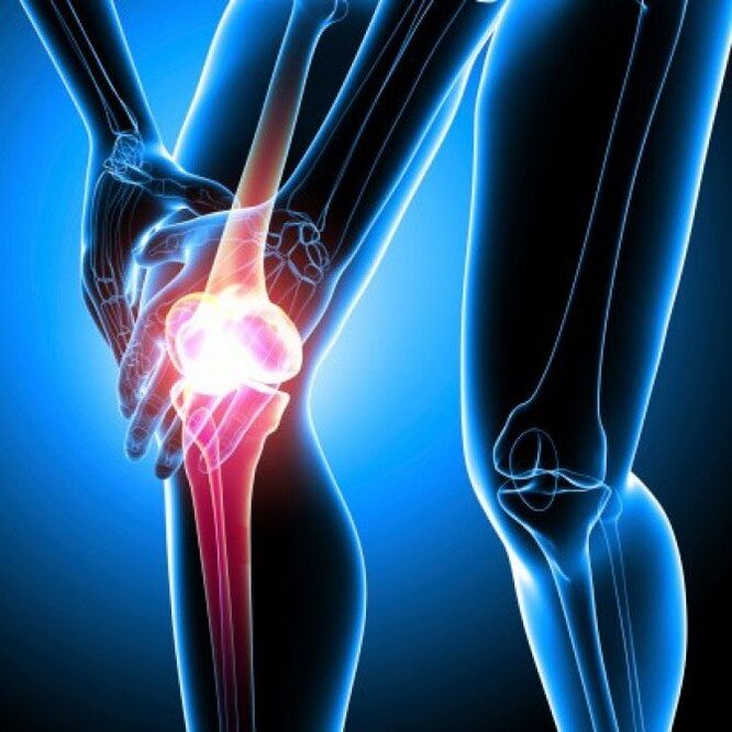 La artritis reumatoide en etapas avanzadas puede causar dolor en la cadera