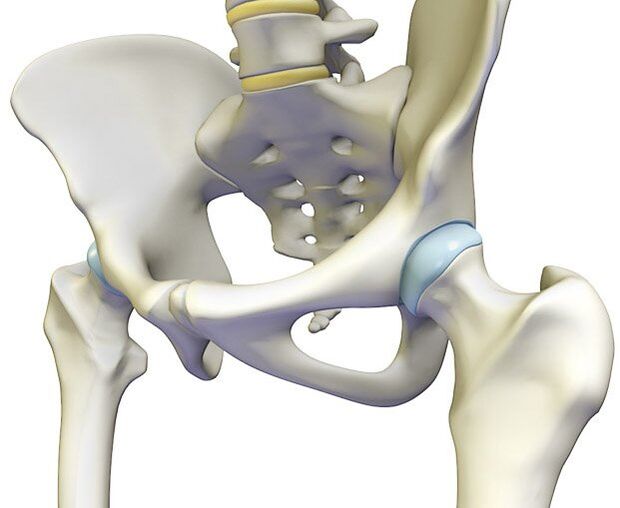La osteocondrosis provoca un dolor intenso en la articulación de la cadera. 