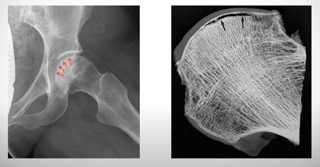 Radiografía de la cabeza femoral afectada por necrosis aséptica