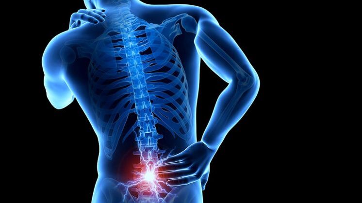 Dolor de espalda con osteocondrosis lumbar.